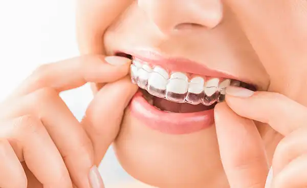 A young woman putting in an Invisalign clear aligner