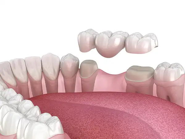 A dental bridge being placed in a mouth