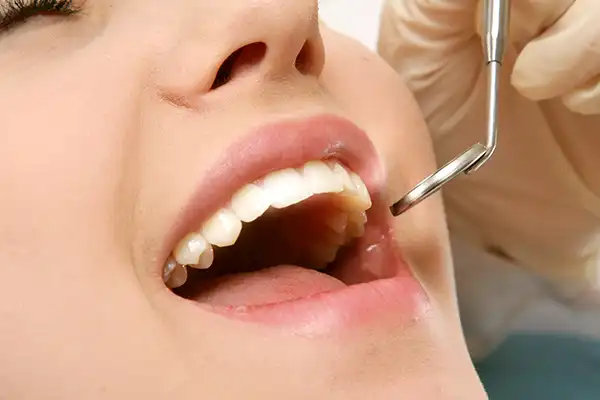 A young woman with her mouth open during a dental exam with mirror showing