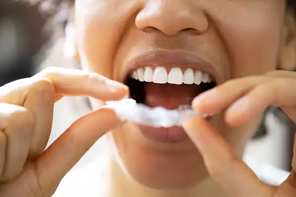 A young woman putting in a mouth guard