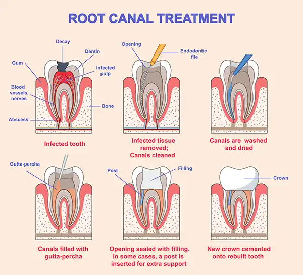 A diagram outlining different phases of periodontal disease