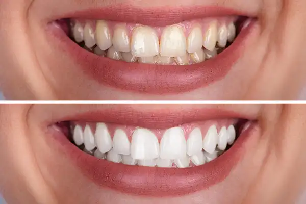 A side-by-side showing teeth before and after whitening