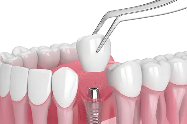 Close-up of a dental implant with crown being placed on the implant illustrated by Highridge Dental Care in Folsom, CA