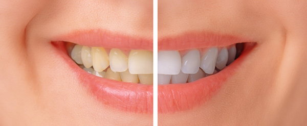Yellow teeth vs. pearly white teeth.